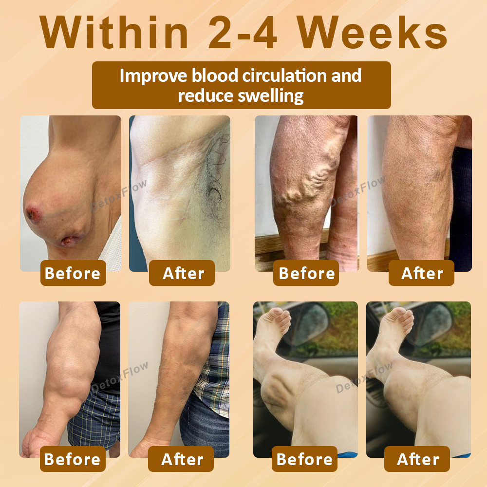 DetoxFlow™ LymphEase Anti-Swelling Herbal Patches