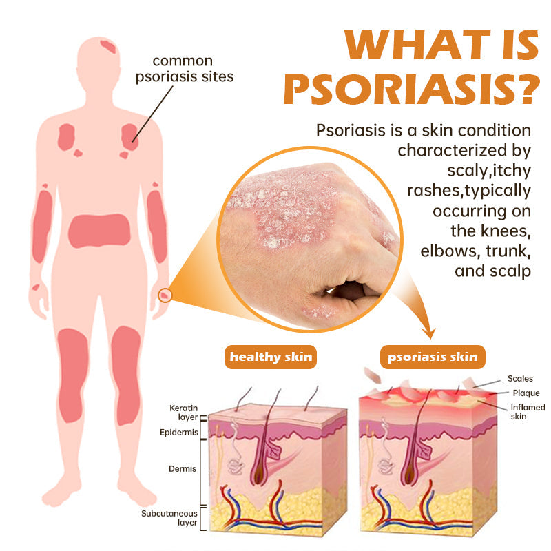 ATTDX™ BeeVenom PsoriasisCream