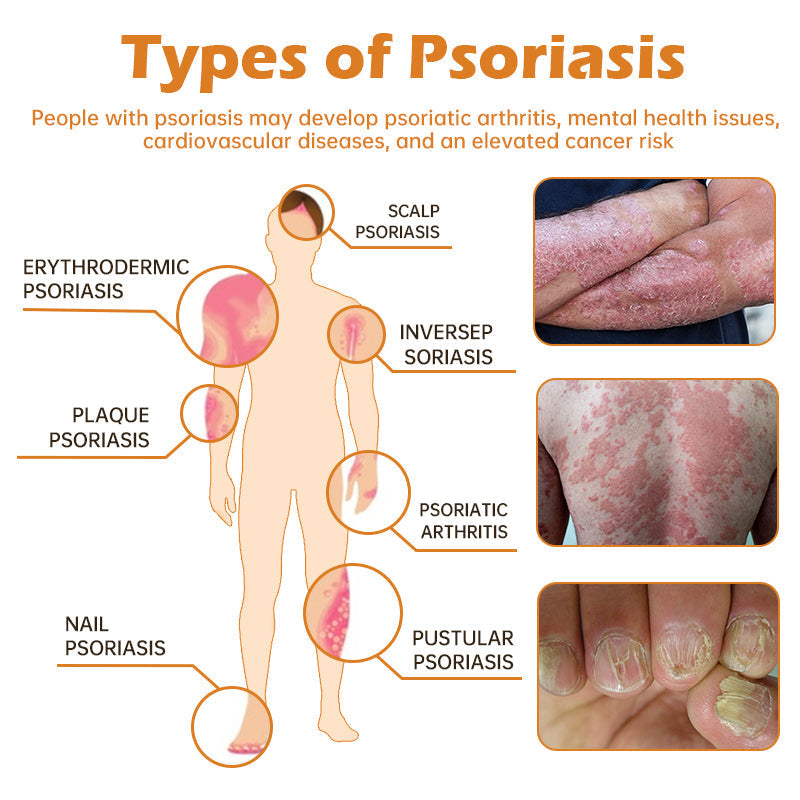 ATTDX™ BeeVenom PsoriasisCream Y