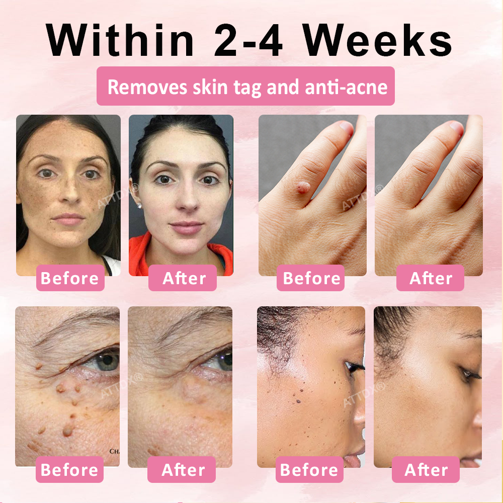 ATTDX® Advanced Fig Tag & Mole Off Capsule Serum