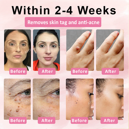 ATTDX® Advanced Fig Tag & Mole Off Capsule Serum