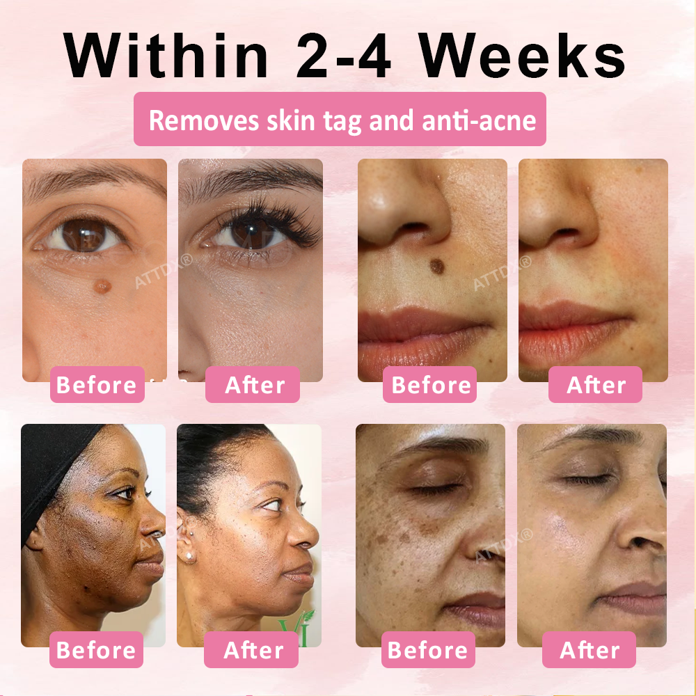 ATTDX® Advanced Fig Tag & Mole Off Capsule Serum
