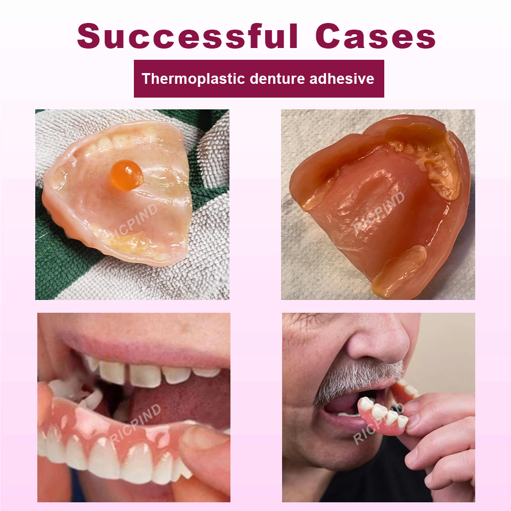 ATTDX™ SmileGrip Thermoplastic Denture Adhesive