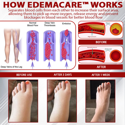EdemaCare™ LymphDrain Horse Chestnut Massage Cream