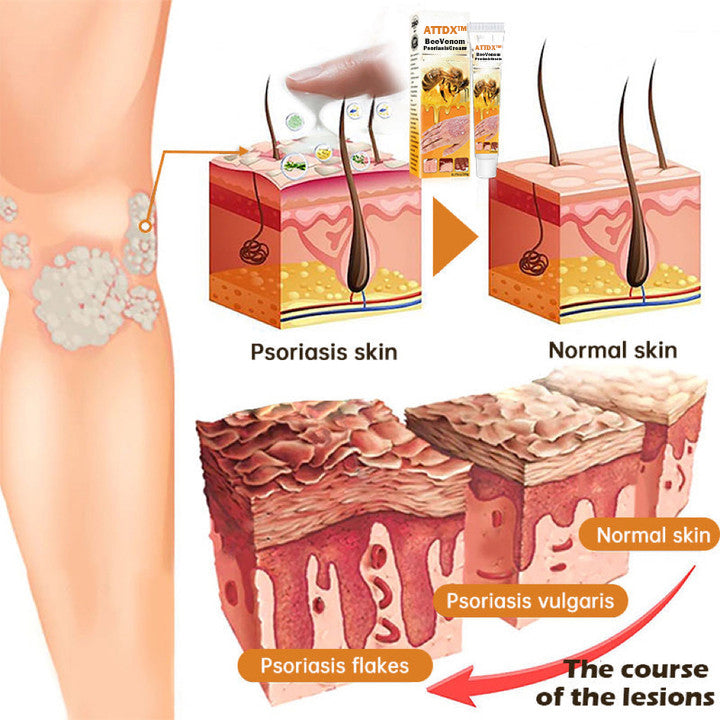 ATTDX™ BeeVenom PsoriasisCream Y