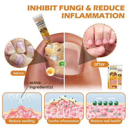 ATTDX™ BeeVenom PsoriasisCream Y