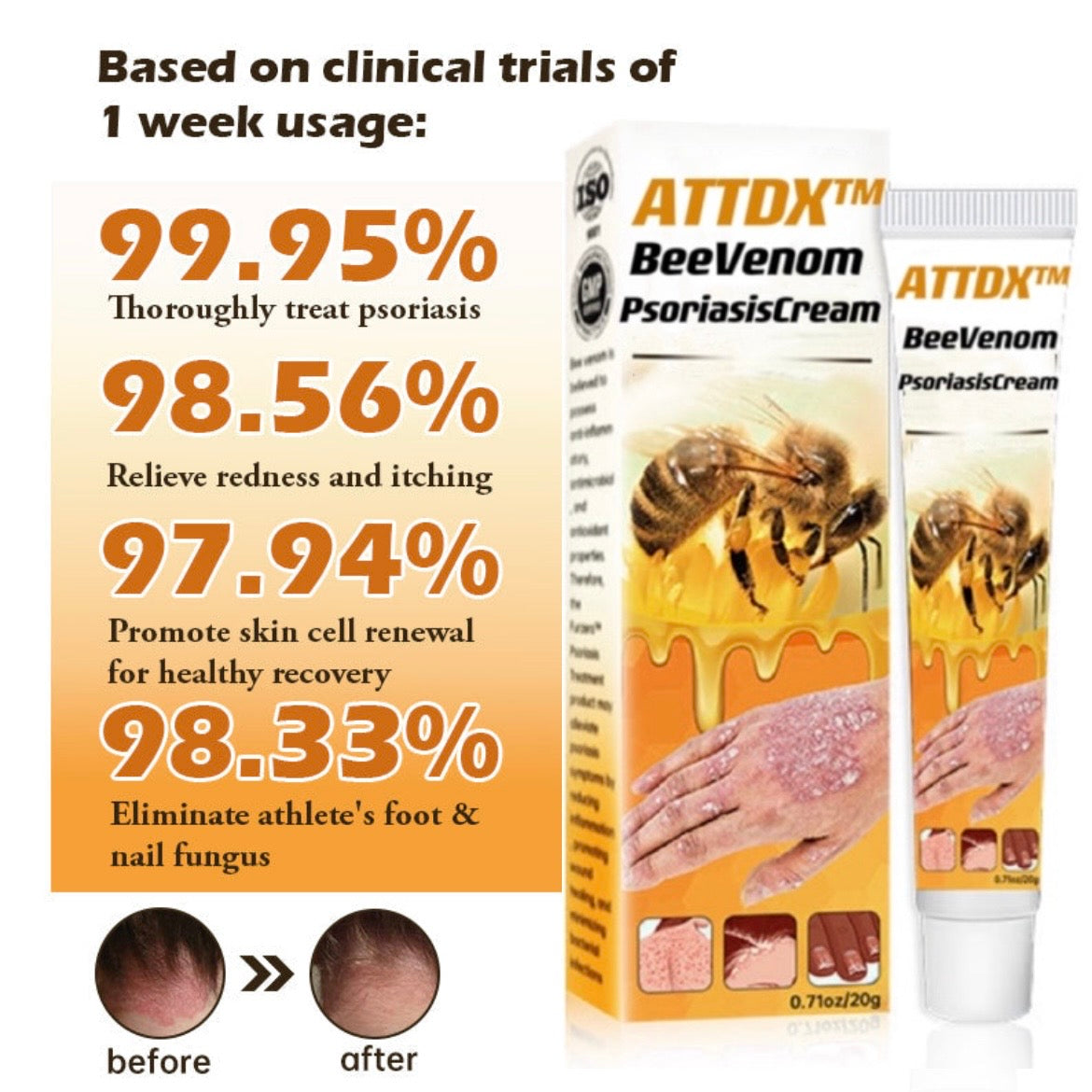 ATTDX™ BeeVenom PsoriasisCream Y